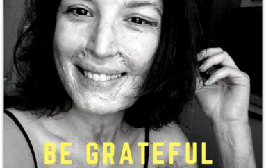 E sulmuan me acid 4 vite më parë në Tiranë, gruaja luftëtare ndryshon rrjedhën e fatit (MESAZHI I FORTË)