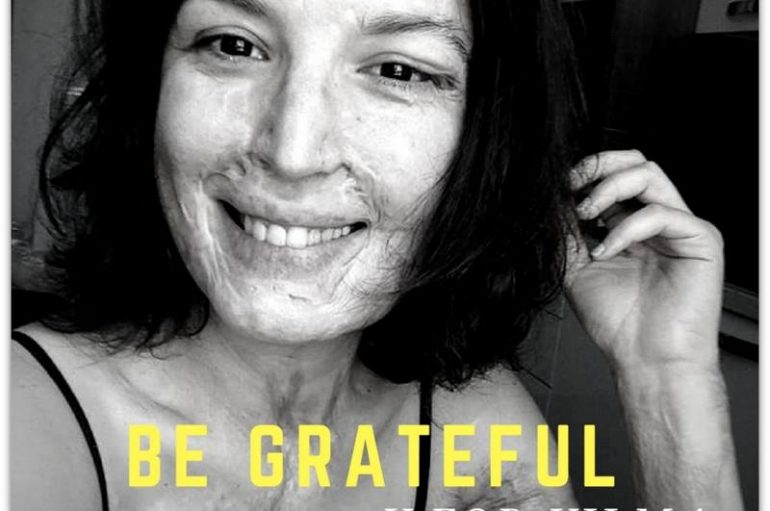 E sulmuan me acid 4 vite më parë në Tiranë, gruaja luftëtare ndryshon rrjedhën e fatit (MESAZHI I FORTË)