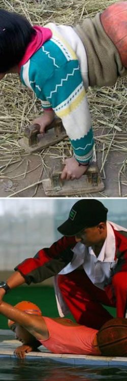 Vajza e vogël që duhej të përdorte një top basketbolli si protezë trupore