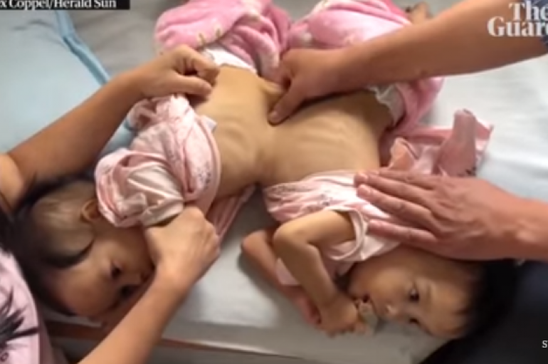 Motrat e ngjitura ndajnë trupin, por jo shpirtin