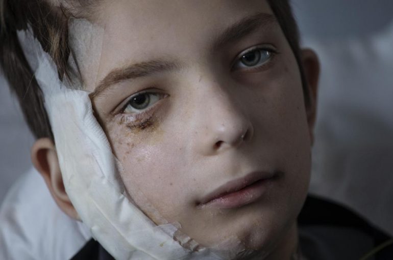 LUFTA/ Fëmijët e plagosur me fytyrë të guximshme në spitalin e Kievit