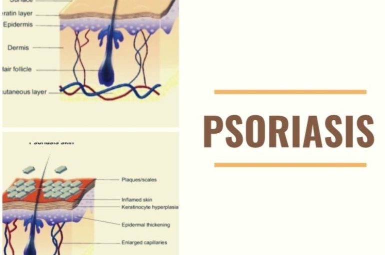 PSORIAZA, SËMUNDJA E LËKURËS QË TË RINJTË E NEGLIZHOJNË, 3% E POPULLSISË E PREKUR