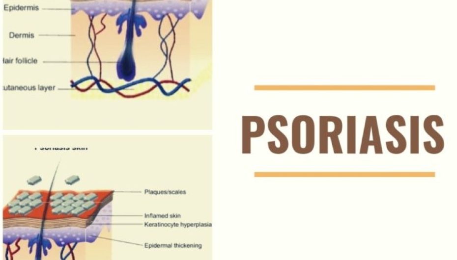 PSORIAZA, SËMUNDJA E LËKURËS QË TË RINJTË E NEGLIZHOJNË, 3% E POPULLSISË E PREKUR